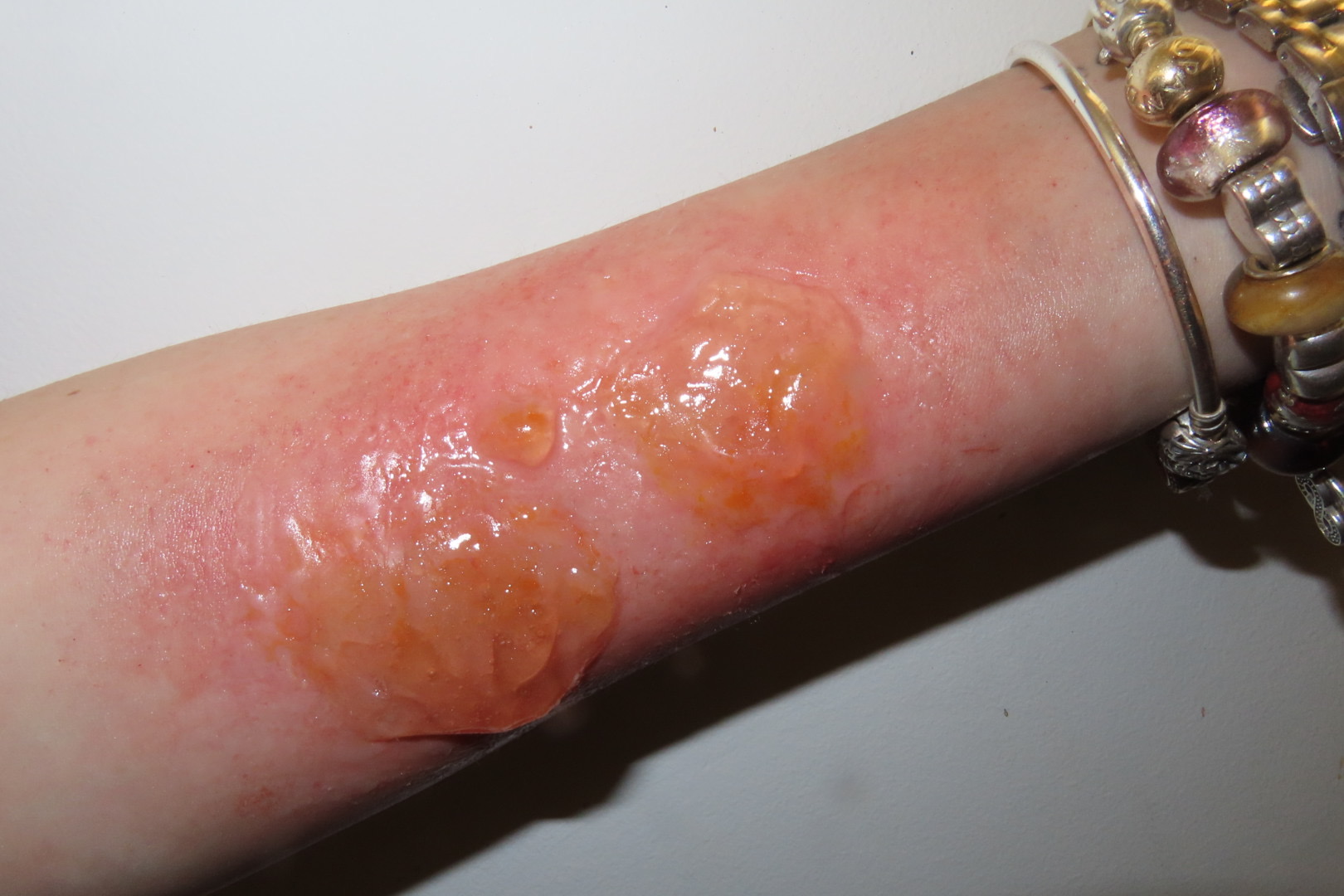 2nd Degree Blister Burn